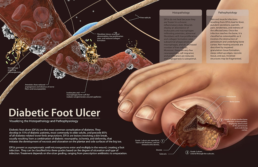 What Are The Causes And Pathogenesis Of Diabetes Foot Ulcers?