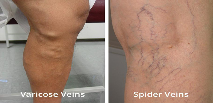 spider veins