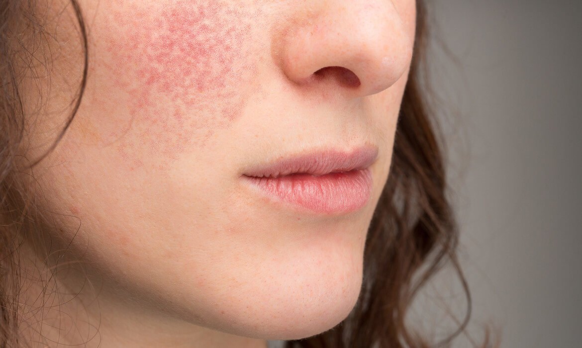 Best Way To Cure Perioral Dermatitis - Is It A Fungal Infection?